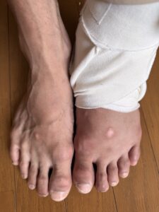  プロのバレエダンサーが、左足首靭帯を損傷してから1週間。ギプス固定・食事の工夫・体幹トレ・治療開始まで、Day 1〜7の経過を記録しました