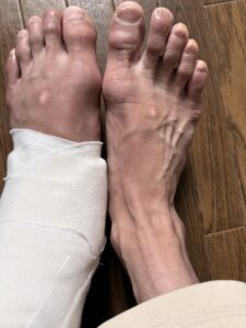  プロのバレエダンサーが、左足首靭帯を損傷してから1週間。ギプス固定・食事の工夫・体幹トレ・治療開始まで、Day 1〜7の経過を記録しました