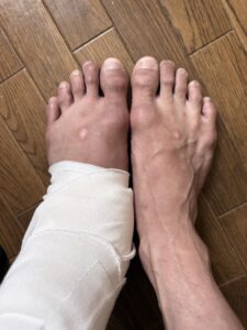  プロのバレエダンサーが、左足首靭帯を損傷してから1週間。ギプス固定・食事の工夫・体幹トレ・治療開始まで、Day 1〜7の経過を記録しました