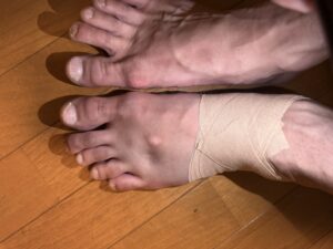  プロのバレエダンサーが、左足首靭帯を損傷してから1週間。ギプス固定・食事の工夫・体幹トレ・治療開始まで、Day 1〜7の経過を記録しました